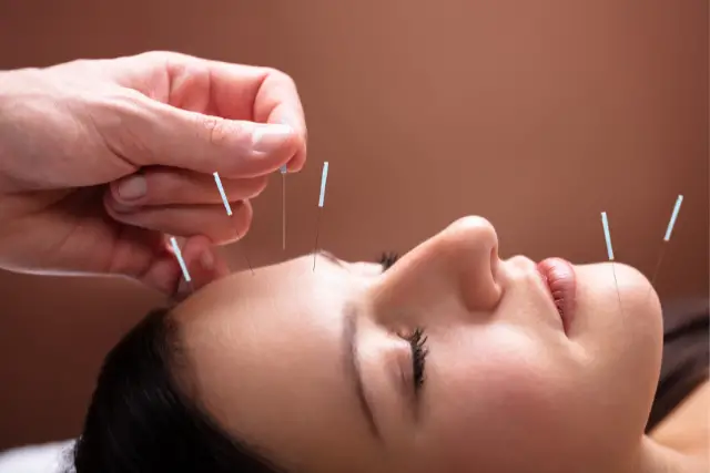 facial acupuncture - featured image